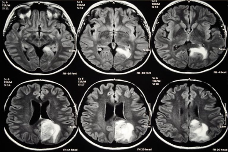 Sabotage by the brain’s supporting cells helps fuel neurodegeneration