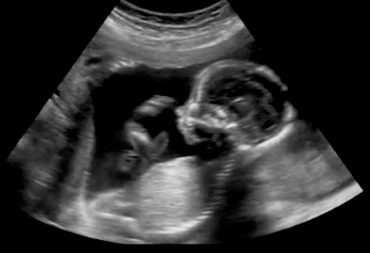 A massive clue on pregnancy and the development of schizophrenia was just found